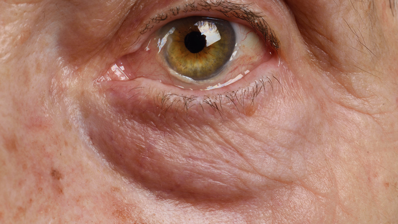 黄斑变性会致盲发现老人视力下降视觉发暗可选用4种疗法