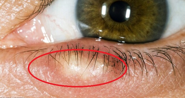 但也可能是睑缘炎,即细菌引起的感染,会使得眼皮上出现皮屑或