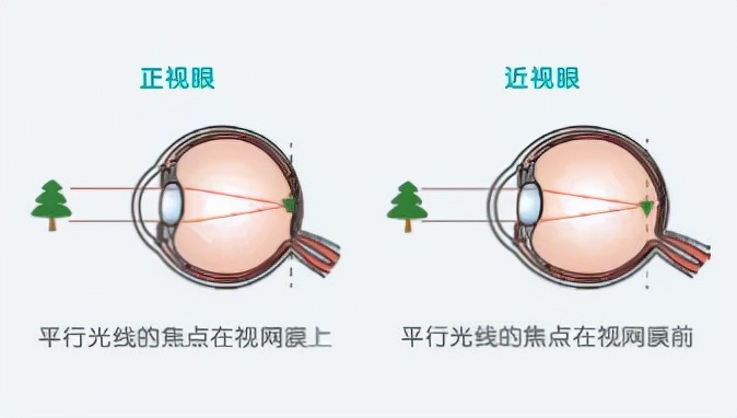孩子近视度数低,可以不戴眼镜吗?
