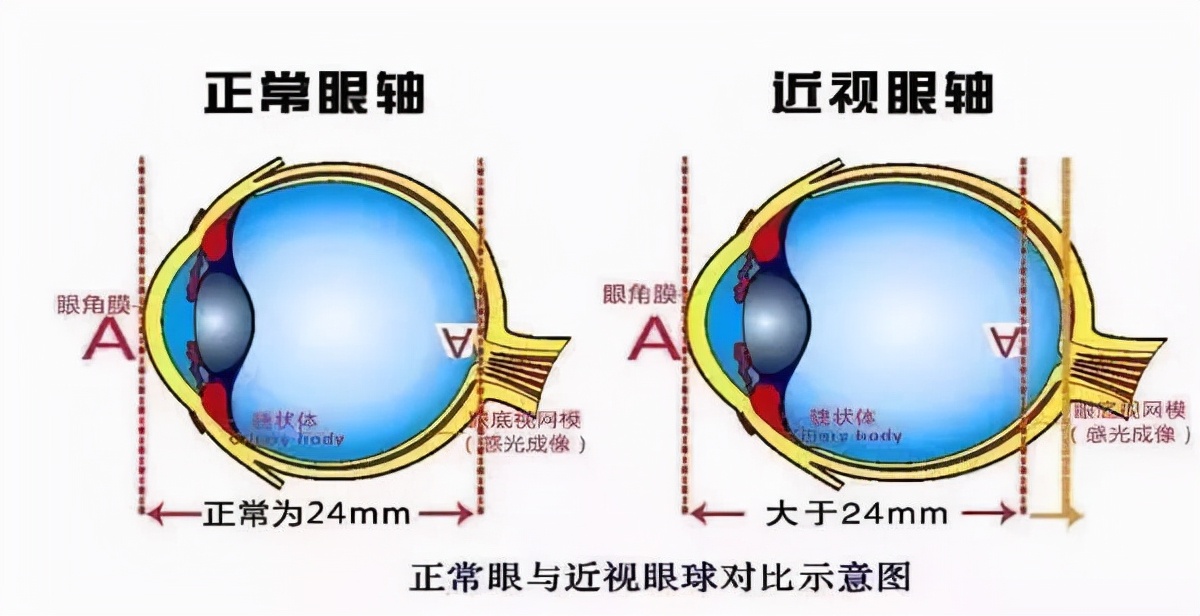 眼睛近视的原理是什么图片