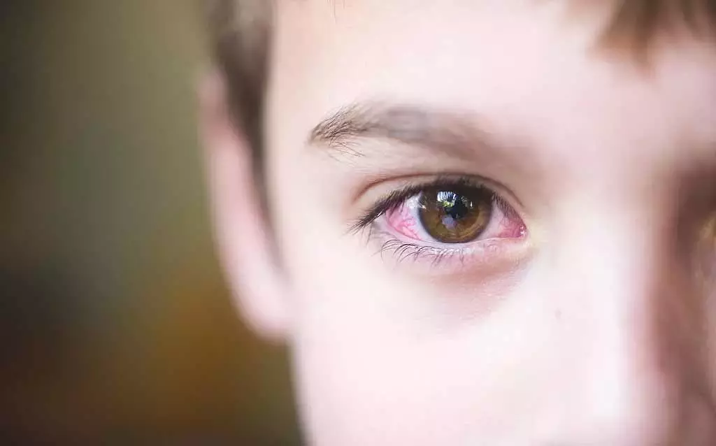 眼睛看东西模糊一定是近视眼吗?