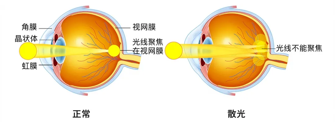 一組圖讓你親眼感受近視,散光,白內障的視界